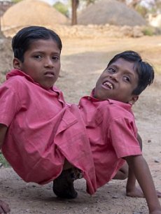 资讯《<em>印度连体双胞胎姐妹</em>获真爱共享一男友》